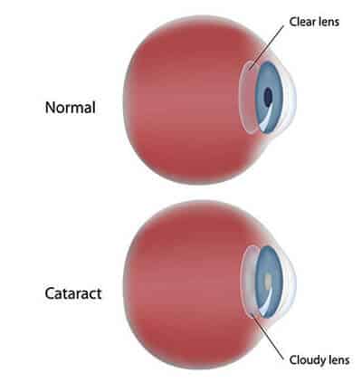Chart Illustrating a Normal Eye Compared to One With a Cataract