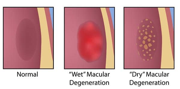 Chart Illustrating Normal, Wet and Dry Macular Degeneration