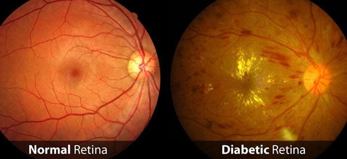 Scan Showing What a Normal Retina Looks Like Compared to a Diabetic Retina